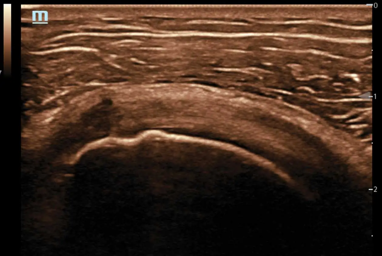 Muscle Tendon Ultrasound Image 